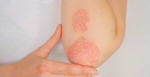 Psoriasis Header