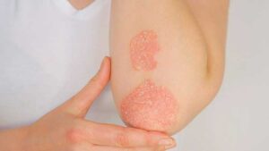 Psoriasis Header min min